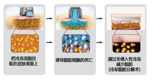 最新溶脂技术，重塑身材的优选之道