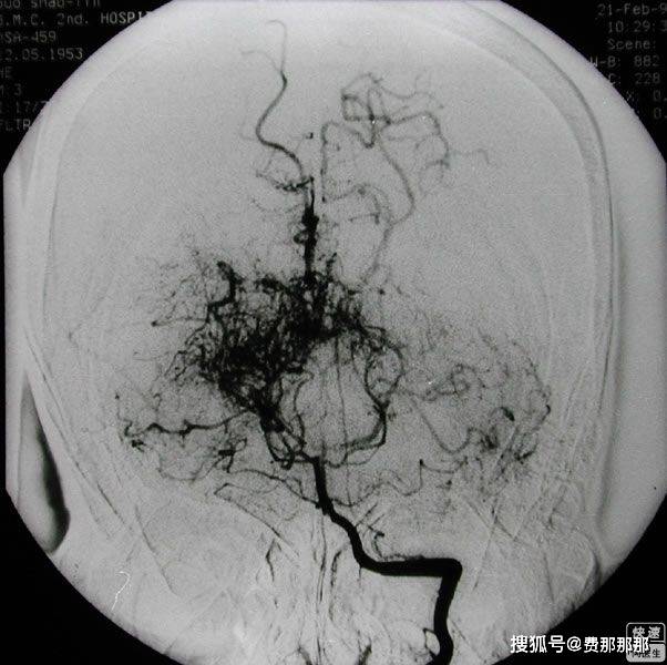 烟雾病最新研究进展与先进治疗策略概述